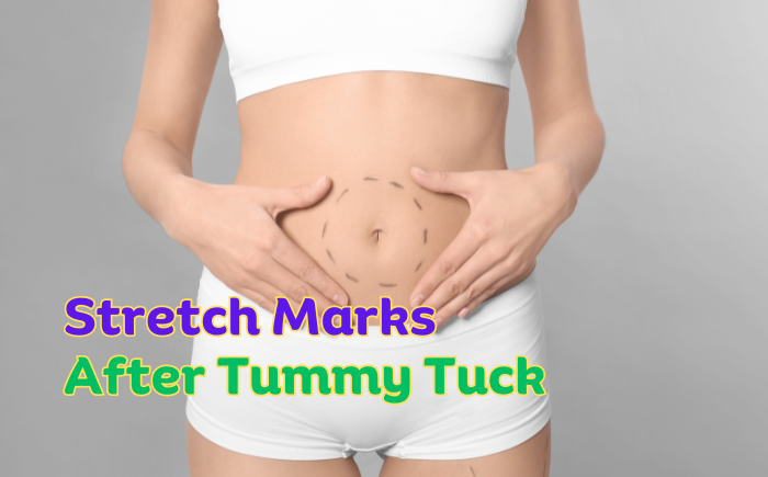 Stretch Marks after tummy tuck